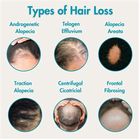 types of hair fall