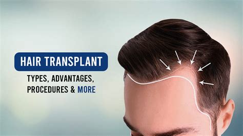 types of hair transplant
